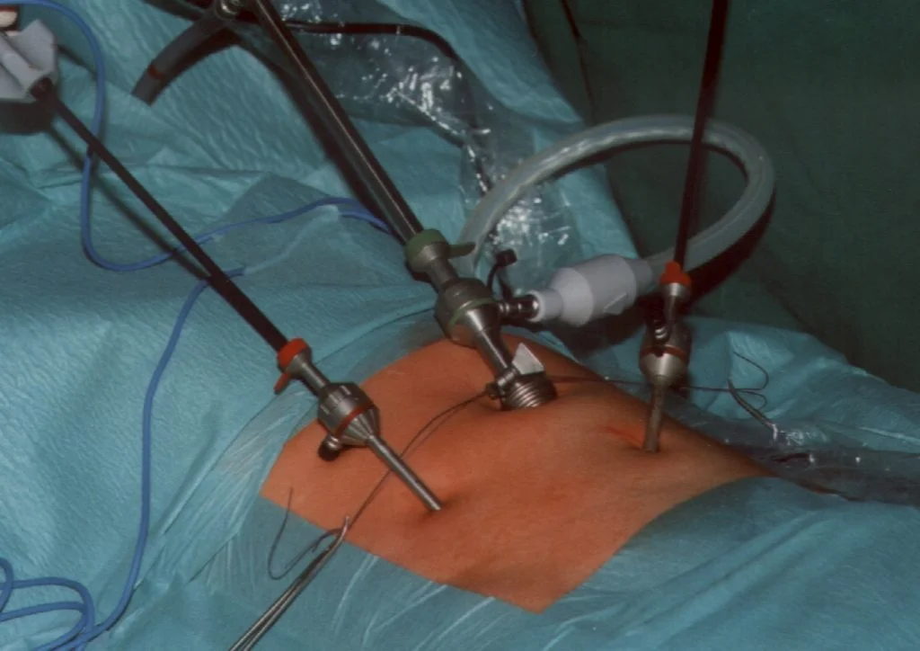 pembedahan laparoskopi