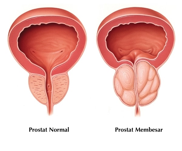 Masalah Kencing Disebabkan Kelenjar Prostat Tips Kesihatan